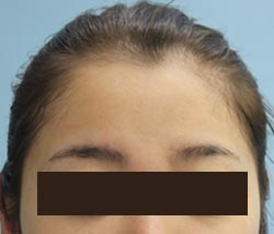 額の整形の手術症例