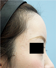 額の整形の手術症例
